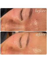 ラディエンス 多治見店/毛穴エステ