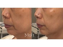 メルト 中目黒(Melt.)/＊サーマジェン