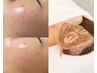 【毛穴開き解決★】毛穴改善ハーブピーリング+保湿成分導入でちゅるん☆¥9990