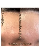 ブリリエット 天王寺店(Brilliet)/＊ハーブピーリング