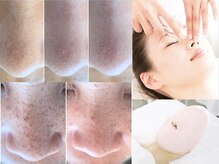 【韓国式３D毛穴洗浄】毛穴の詰まりやしみケアに◎即効ツヤ肌へ