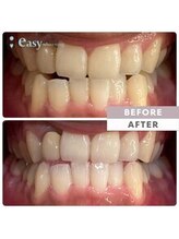 イージーホワイトニング 神戸三宮店(easy whitening)/お客様の症例写真です★
