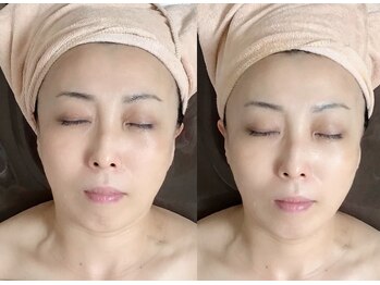 メディカルサロン かとれあ/リフトアップ