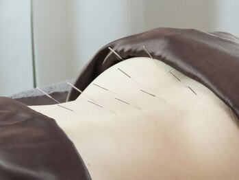 和楽治療院 神楽坂/鍼灸施術