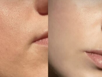 ビジュー(BIJOU)/ララピール+水玉リフティング