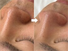 シェアリー(sharely..)の雰囲気（毛穴洗浄で黒ずみ、角栓をとりぴかぴかのお肌に☆/美肌）