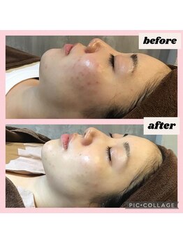 エヴァーグレース 河原町店/京都河原町の毛穴改善美肌サロン