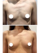 エムエム(mm)/バストアップ/育乳/バストケア/