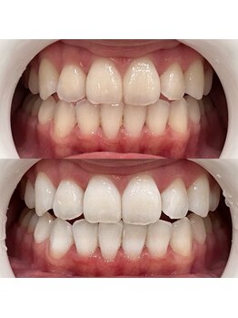 ハリス(HARIS)/セルフホワイトニング