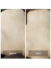 アーユルヴェーダアンドアロマエステ アユス(AYUS)/ハーブピーリング　背中