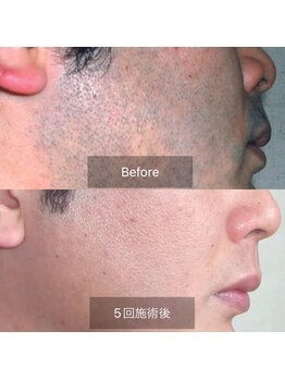 カルナ(CARNA)/ヒゲ脱毛（5回施術）