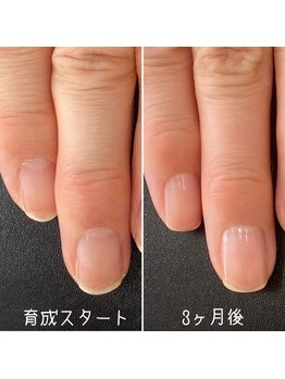 ネイルズ アヴァンティ(Nails Avanti)/「爪育成」最強ケア3ヶ月コース