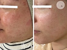 LUNEA/《症例》ニキビケア