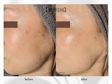 アン ビューティー(ann beauty)/施術1回【症例写真】50代