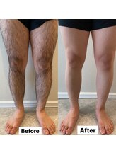 ハチ シンス 2023-(hachi-since 2023-)/【メンズ脱毛】　Before・After