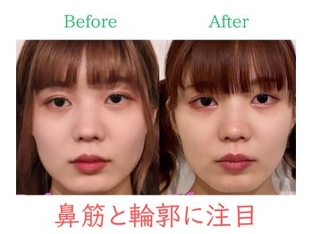 ラプリ 福岡天神店(Raplit)/隆鼻+輪郭・小顔矯正 美鼻/小顔