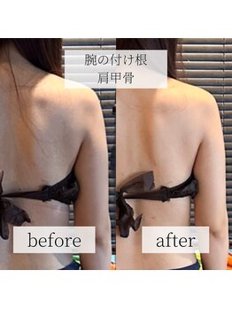 ミーツ(MEETS)/ブライダル 肩甲骨/二の腕 1回