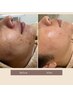 vosサロンケア15万本肌質改善《3日分ホームケア付》 