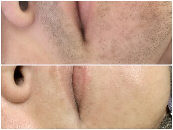 カルム(Calme)/ヒゲ脱毛 30台