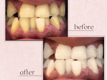 ルアナシンフォニア エクシア 池袋店(Luana-Sinfonia)/ホワイトニングビフォーアフター