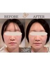 チョコバリ 錦糸町店(chocobari)/小顔×リフトアップ(美容鍼)30代