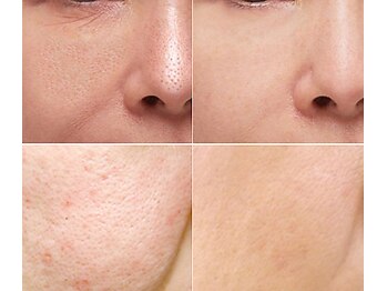 ナチュレアンドメディカ(Nature&Medica)/毛穴特化ケア(YAGカーボン)