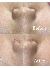 ホワイトワックス 沖縄店(WHITE WAX)/小鼻の産毛・黒ずみもスッキリ