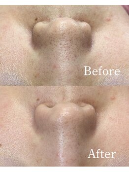 ホワイトワックス 沖縄店(WHITE WAX)/小鼻の産毛・黒ずみもスッキリ