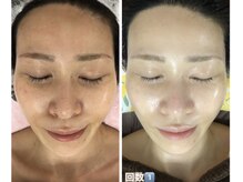 アルページュ(Arpege)の雰囲気（かぼちゃ宝石ピール×LDM★毛穴くすみニキビ◎角質整肌×守り）