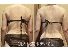 アクアリジェ/痩身リンパ　施術２回の変化