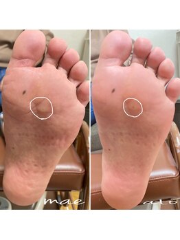 ペル(Per)/魚の目もケアします！