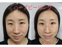 ウェルフル(Well Full)/ハーブピーリング＆ヒト幹細胞液