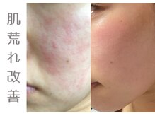 アニール(aniR)/フェイシャル/フェイシャル/毛穴