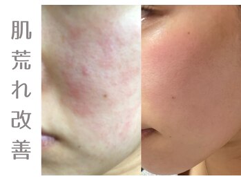 アニール(aniR)/フェイシャル/フェイシャル/毛穴