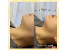 ナスサロ/レモンボトル