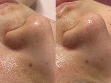 ホーミー(Homie)/毛穴黒ずみ、毛穴開き改善