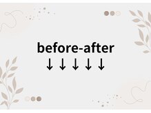 リリ(lili)/巻き爪ケア/巻き爪を防ぎます。