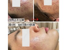 ルナティアラ(LUNAティアラ)の雰囲気（男性ニキビケア　赤味　上質人幹細胞導入週1回　60日後の変化）