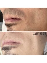 メリアミーゴ(Meli amigo)/【メンズ】ヒゲ脱毛