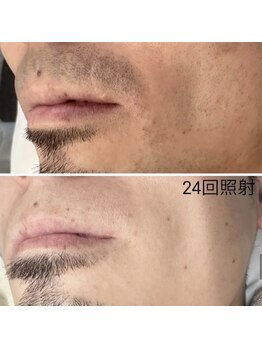 メリアミーゴ(Meli amigo)/【メンズ】ヒゲ脱毛