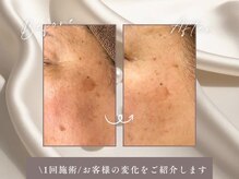 ハリーネ(HARINE)の雰囲気（シミケアでの変化！シミが改善されています♪）