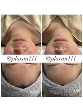 プララン 京都桂店(Plaran)/ハーブピーリング