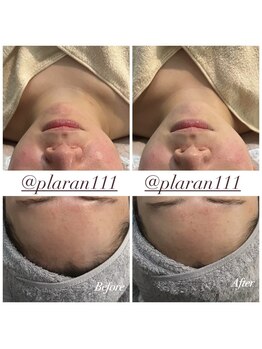 プララン 京都桂店(Plaran)/ハーブピーリング