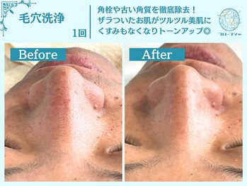 フローフシ∞/【毛穴洗浄】毛穴の黒ずみ解消