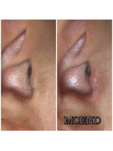 モエンド(MOEND)/耳毛