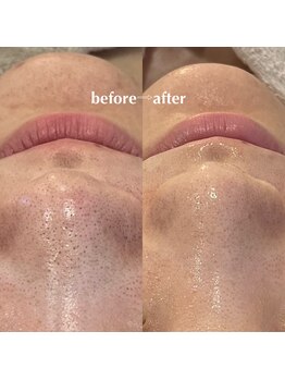 リモアボーテ(RIMOA beaute)/【毛穴】before→after