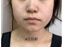 エステティック レイビス 池袋店(RAYVIS)/ハーブピーリング4日後朝