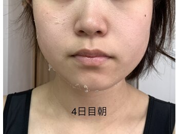 エステティック レイビス 池袋店(RAYVIS)/ハーブピーリング4日後朝