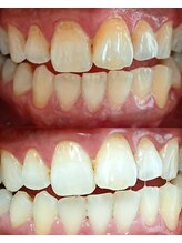 ベル(BEL)/クリスタルホワイトニング