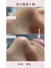 ル シャ/メンズ脱毛/毛穴洗浄/ヘッドスパ